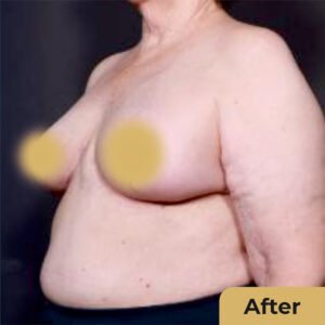 Breast Reduction 02