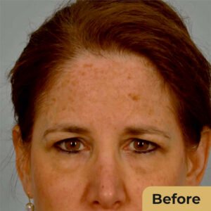 Brow Lift 01