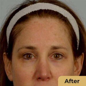 Brow Lift 02