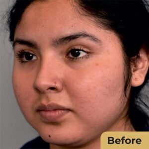 Buccal Fat 01