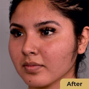 Buccal Fat 02