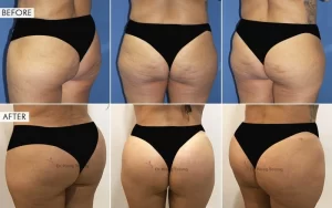 Butt Silicon Implants