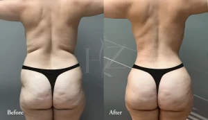 Butt Silicon Implants(2)