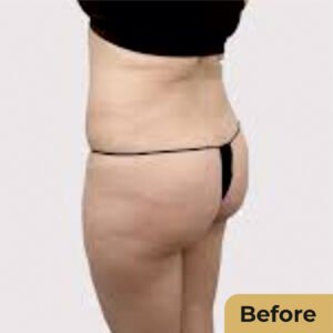 Buttock Lift 01