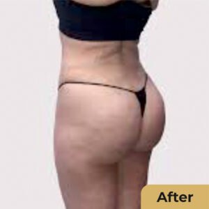 Buttock Lift 02