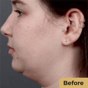 Cheek Fat Reduction 01