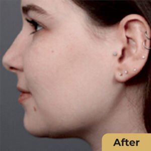 Cheek Fat Reduction 02