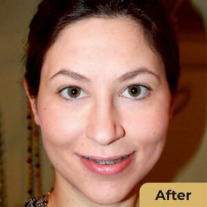 Chemical Peel 01