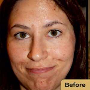 Chemical Peel 02