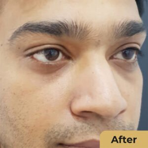 Eye lid 02