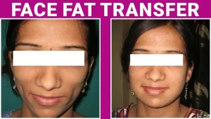 FAT GRAFTING(3)