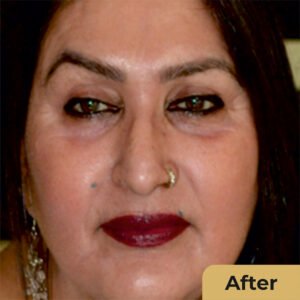 Face lift 01