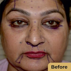 Face lift 02