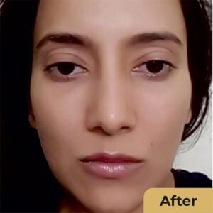 Filler treatment 01