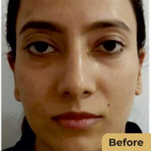 Filler treatment 02