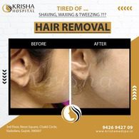 laser hair removal before/after