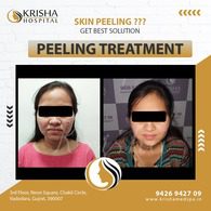 peeling treatmeant before/after