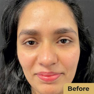 Hydra Facial 01