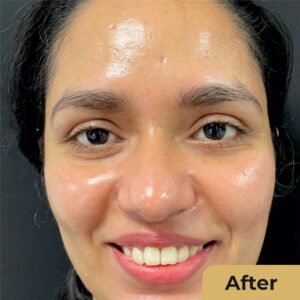 Hydra Facial 02