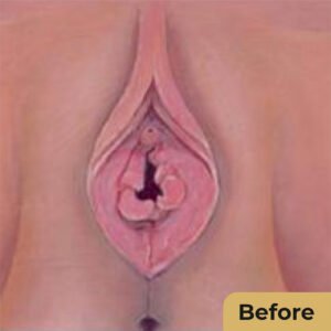 Hymenoplasty 01