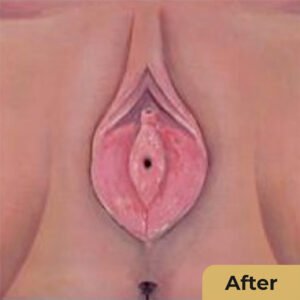 Hymenoplasty 02
