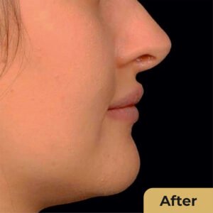 Jaw Contour 002