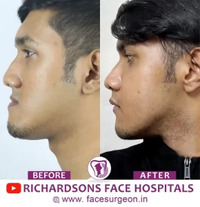 Jaw Contour(3)