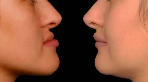 Jaw Contour(5)