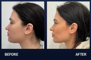 Jaw contour(1)