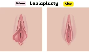 LABIAPLASTY
