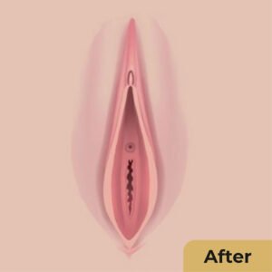 Labiaplasty 02