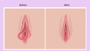 Labioplasty and Vaginoplasty