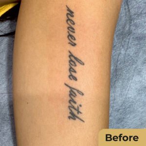 Laser tattoo removal 01