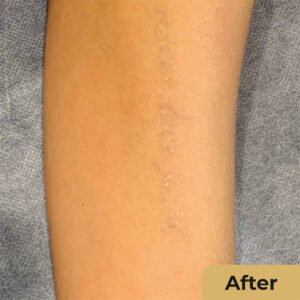 Laser tattoo removal 02