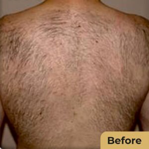 Lazer hair removal 01