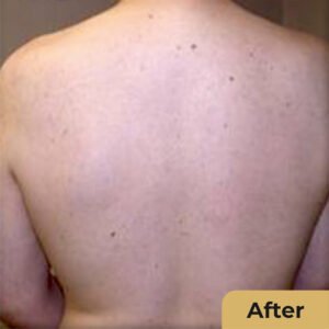 Lazer hair removal 02