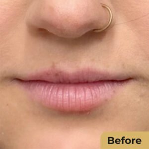 Lip Contouring 01