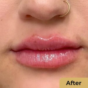 Lip Contouring 02