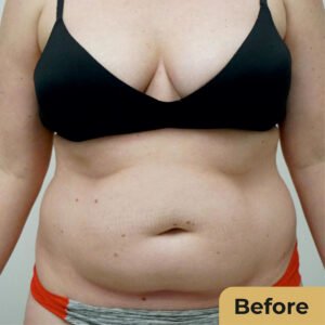Liposuction 01