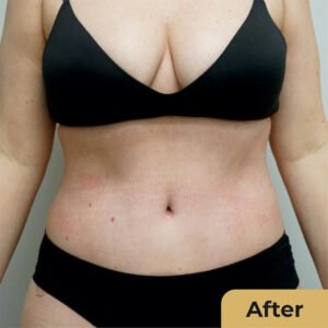 Liposuction 02