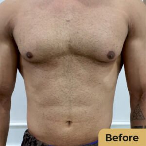Male Breast Reduction 01