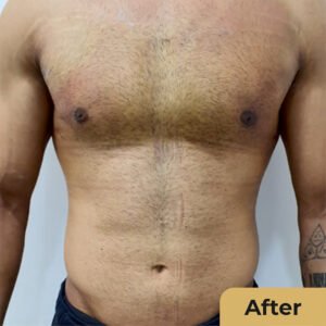 Male Breast Reduction 02