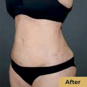 Mega Liposuction 01
