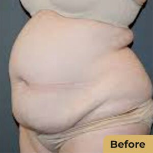 Mega Liposuction 02