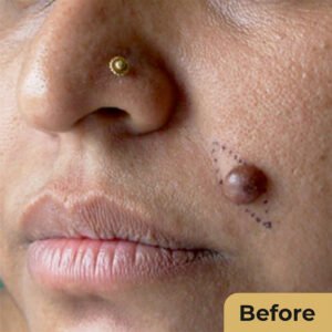 Mole Removal 01