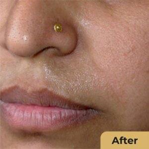 Mole Removal 02