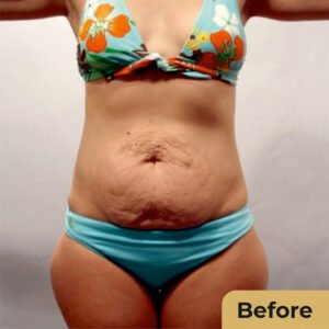Mommy Makeover 01