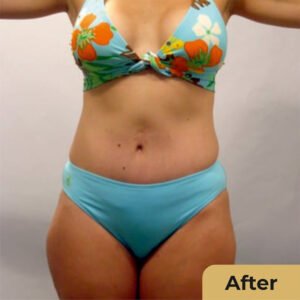 Mommy Makeover 02