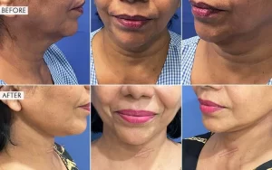 NECK LIFT3