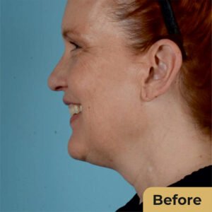 Neck Lift 02